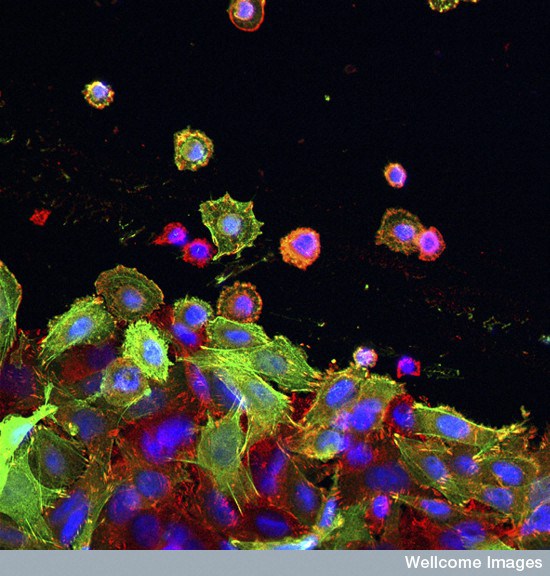 B0006844 Colon cancer cells Credit: Lorna McInroy. Wellcome Images images@wellcome.ac.uk http://images.wellcome.ac.uk Cultured colon cancer cells showing the nuclei stained with DAPI in blue, the actin cytoskeleton in red and plectin (isoform 1k) in green. Plectin interacts with cytoskeletal actin, affecting its behaviour. This subtype of plectin promotes the migration of cells and may affect metastasis. Confocal micrograph 2005 Published:  -  Copyrighted work available under Creative Commons by-nc-nd 2.0 UK, see http://images.wellcome.ac.uk/indexplus/page/Prices.html